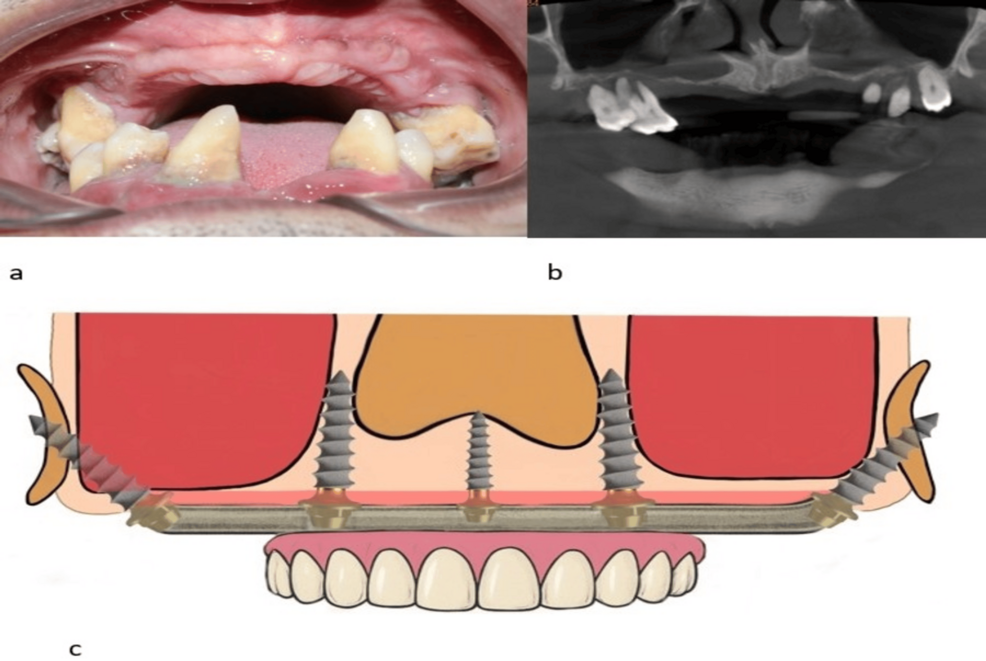 Dinți ficși fără adiție de os