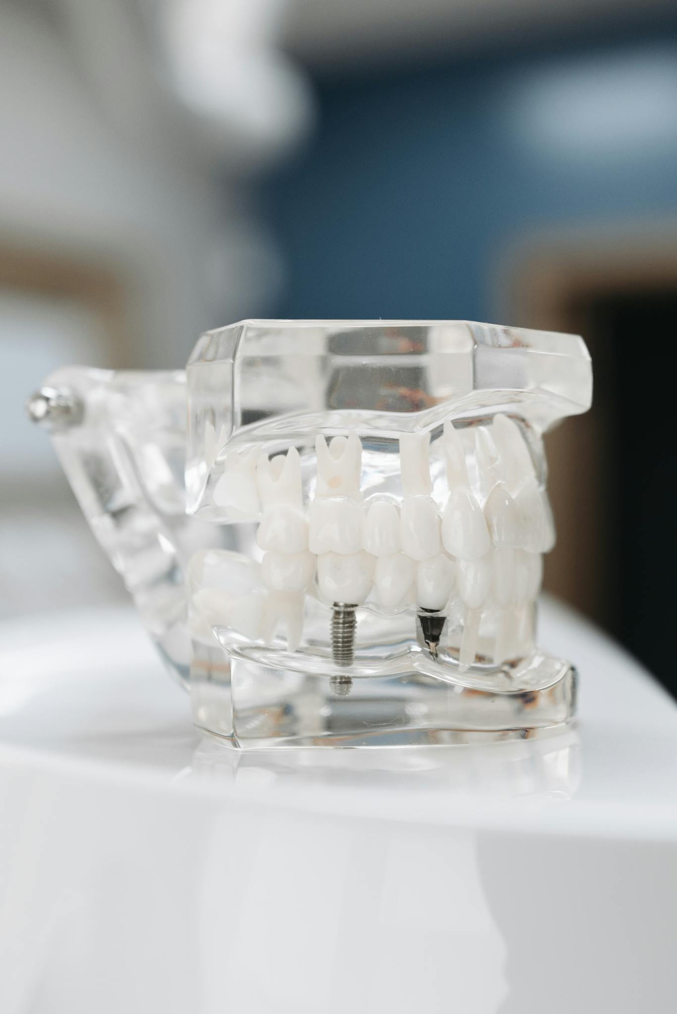 Transparent dental model showing teeth and implant screws, perfect for educational purposes.